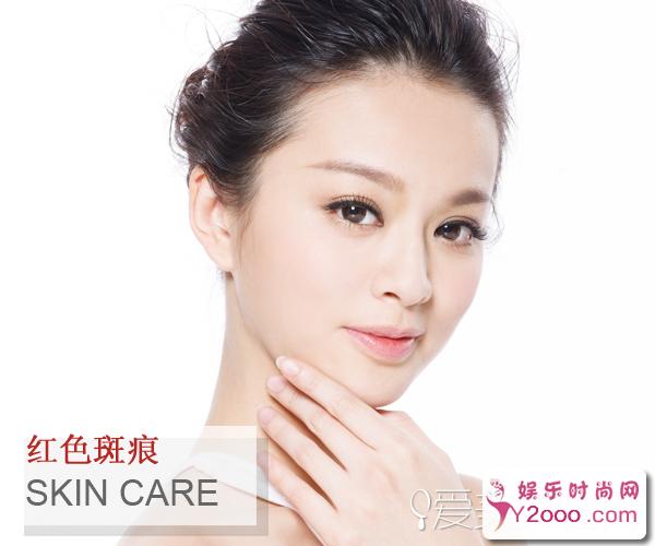  祛痘印的小窍门 祛痘不留"印"象 