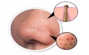 黑头形成的原因及彻底去黑头的方法步骤 黑头形成的原因及彻底去黑头的方法步骤