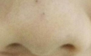 草莓鼻怎么去除最有效？教你三招去黑头的方法