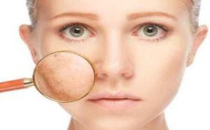 激光祛斑见效快 但危害不可小觑 激光祛斑见效快 但危害不可小觑