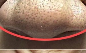 如何改善毛孔粗大的问题