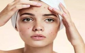 挤黑头留下的黑印怎么办？如何去掉黑印方法