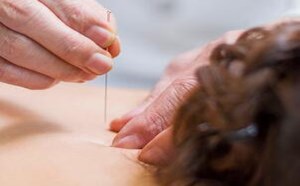 如何利用针灸减肥 针灸减肥要坚持多久才有效？